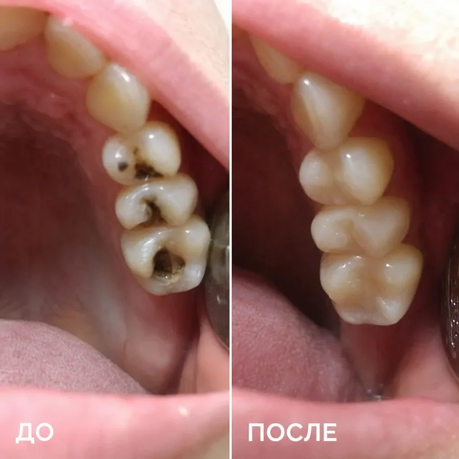 Лечение кариеса